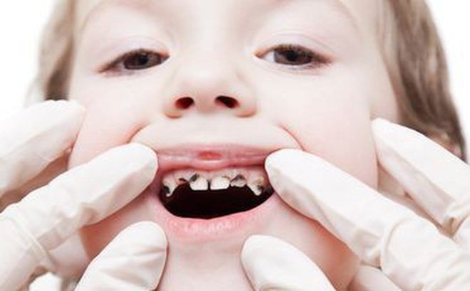 Tác hại của sâu răng trẻ em | Vinmec