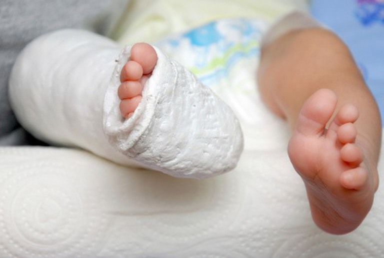 Trẻ Đi Nhón Chân Có Phải Bị Tự Kỷ Không?